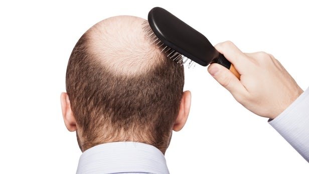 مکمل بیوتین در جلوگیری از ریزش مو موثر است؟